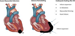 In this review article, we make the case that this interpretation is not consistent with the clinical and experimental data on the topic. Molecular Imaging To Monitor Left Ventricular Remodeling In Heart Failure Springerlink