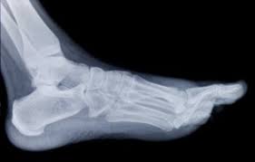 Image result for Foot Fracture