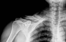 Image result for Shoulder XRay