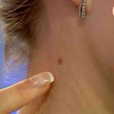 Rodinki Na Shee Prichiny Poyavleniya Kak Udalit Rodinku Na Shee