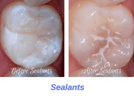 Dental sealants are effective but underused protection against cavities. Dental Sealants Oceansight Dental Implants