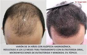 Both medications are used to treat hair loss. Dutasteride And Minoxidil Before And After Photos Hair Loss Cure 2020