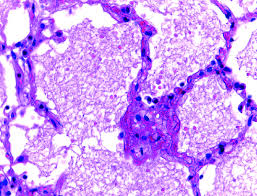 Parénquima pulmonar con edema intraaveolar (H/E 40×).