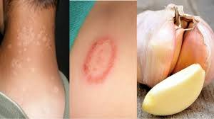 Kurap juga dikenal sebagai dermatofitosis atau tinea, adalah infeksi jamur pada kulit. Petua Berkesan Sembuhkan Penyakit Kurap Setelah 15 Tahun Menderita Dengan Bawang Putih Kartel Dakwah