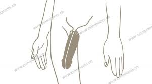 The phalloplasty is a common surgical choice for transgender and nonbinary people interested in gender confirmation surgery. La Faloplastia Resumida Zephyr Surgical Implants