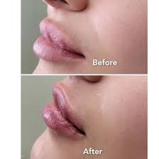 Dermal Fillers