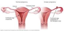 Image result for icd 10 code for tubal pregnancy