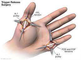 Write down your aol username id, your password, your answer to the security question and keep it in a safe and secure place. Tendon Rupture Following Trigger Finger Release Medmovie Com