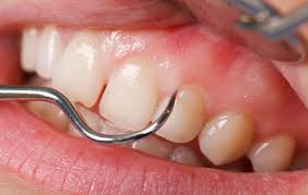 Color Changes To Your Gums Boulder Dentist Family Cosmetic Dentistry Dr Ania Mohelicki