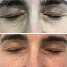 Image result for xantelasma