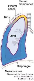 An effusion is a medical emergency, particularly in people with mesothelioma and will need to be treated as soon as possible. 30 Mesothelioma Draft Ideas Mesothelioma Cancer Lunges