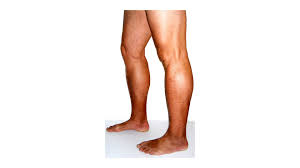 Image result for Lipodermatosclerosis