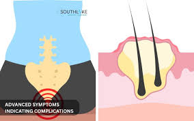 Image result for Pilonidal Cyst