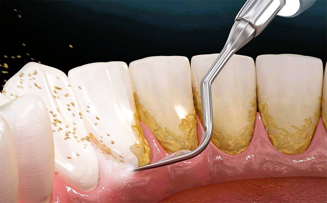 Teeth Cleaning in Siliguri product image