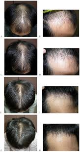 Men may start showing signs of baldness by the time they are 30 years. Long Term 10 Year Efficacy Of Finasteride In 523 Japanese Men With Androgenetic Alopecia