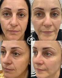 In accordance with the latest requirements recently released by the TGA we  are unable to advise what this treatment was. Registered Nurse: Tanya  Please get in touch with our team who will