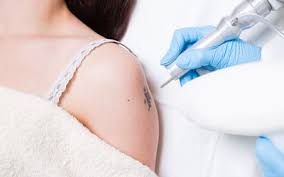 If you are ready to have your radiation tattoo removed for free and have had clearance from your oncologist, please call removery. Tattoos For Breast Radiation Therapy