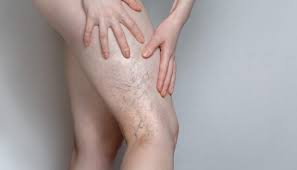 Why Winter Is The Best Time To Banish Varicose Veins With Sclerotherapy Metroderm Dc Medical Laser And Aesthetic Dermatology Center Board Certified Dermatologists