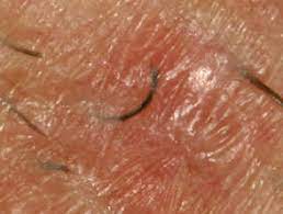 An infected cyst can result from various reasons. Folliculitis Barbae And Pseudofolliculitis Barbae Dermnet Nz