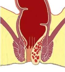 Veraltete bezeichnungen blinde adern, goldene adern, goldadern). End Und Dickdarm Zentrum Essen Hamorrhoiden