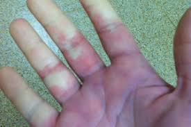Overview signs and symptoms contributing risk factors recommendations. My Hands And Feet Are Always Cold Should I Worry Health Essentials From Cleveland Clinic