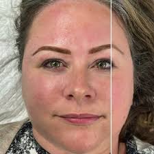 Do you know why the microblading tool makes a Velcro sound when it's  scratching the skin? 💁🏼‍♀️I go over all steps of a microblading procedure  from beginning to end in this video