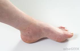 What Causes Swollen Hands And Feet With Pictures