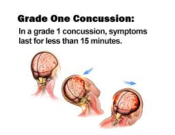 Image result for Concussion Grading