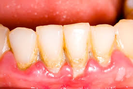 Image result for Gingivitis