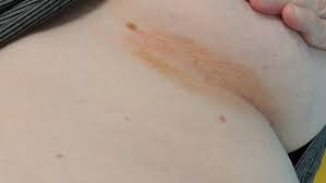 Image result for Erythrasma