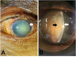 Image result for Lens Dislocation