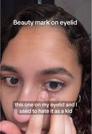 Embracing Beauty Marks: A Personal Journey