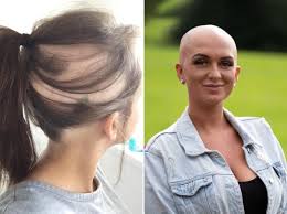 A bald head subverts what has come to. Alopecia Sufferer Sick Of Hiding Bald Patches Shaves Her Head Metro News