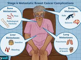 What are the differences between metastatic breast cancer, stage 4 breast cancer and advanced cancer? Complications Of Advanced Metastatic Breast Cancer