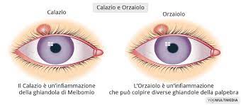 Orzaiolo Cause Sintomi E Cure Centro Oculistico Poliambulanza