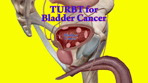 Turbt How To Do Transurethral Resection Of Bladder Tumor Bladder Cancer Surgery Youtube