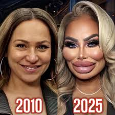 Darcey Silva's SHOCKING Face After Removing Fillers From Her Face!