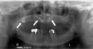 Die Videoassistierte Endoskopische Sinusrevision Zur Therapie Der Chronischen Einseitigen Dentogenen Sinusitis Maxillaris Springerlink