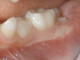 6 Year Old Molars And How To Help During Their Eruption Kiddies Dental Care
