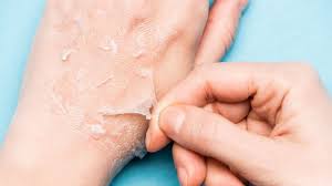 Dry peeling skin: 7 home remedies you can try | HealthShots