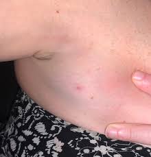 When this happens, a person may notice raised, flushed, itchy spots. Pimple Ingrown Hair 3rd Nipple Help Hot Topics Forums What To Expect