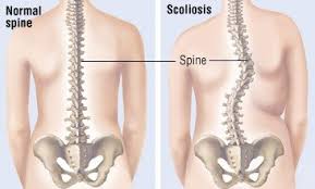 Based on what i learned, those with scoliosis usually have unbalanced shoulders, pelvis or back pain, and i have non of those, ever. Scoliosis Guide Causes Symptoms And Treatment Options