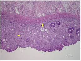 Image result for Radiation Colitis