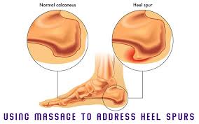 A bone spur also occurs in people suffering from osteoarthritis. Treatment For Heel Spurs Massage Professionals Update