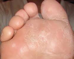 Bataturi sau clavus sunt termeni sinonimi cu calozitatea, un raspuns hiperkeratozic la trauma; Bataturile Plantare Nu Se Trateaza La Cosmetician Sau Dermatolog Si Nu Se Indeparteaza Chirurgical Medlife