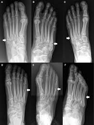 It is the second longest metatarsal. Fifth Met Fractures And Osteoporosis In Women Lower Extremity Review Magazine