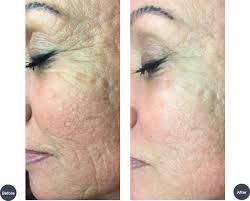 „er beseitigt heißt eben nicht, dass er sich dem medizinischen gebäude ausliefert, sondern dass er die. Mezotix Corinna Schroder Kosmetik Saarbrucken Anti Aging Hydrafacial