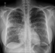 Mycoplasma Pneumonia Bilateral Reticular Nodular Interstitial Infiltrates With More Focal Patchy Alveolar Opacity In The R Radiology Pleural Effusion Tension