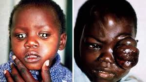 Childhood acute leukaemia is caused by genetic mutations and a lack of childhood infection, scientists say. Just In Causes Of Childhood Cancers Largely Unknown The Herald