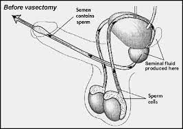 Even though the overall amount of ejaculate a man produces will be reduced by 2% to 5% after a vasectomy, that does not affect the intensity of the orgasm. Where Does Sperm Go After Vasectomy Pollock Clinics